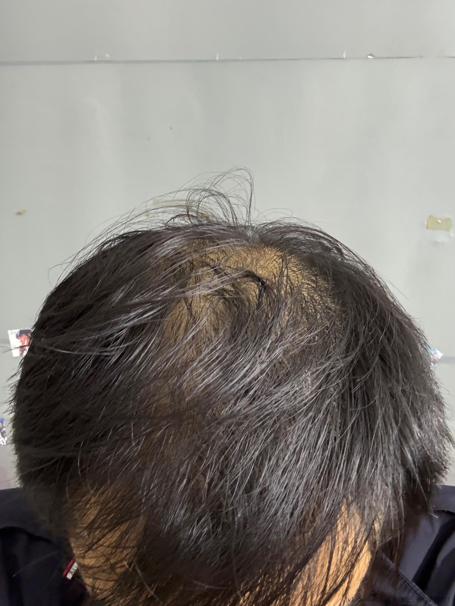 M+秃顶脱发几年了，最近想用米诺试试，兄弟们，帮忙看看给点建议 - 线报酷